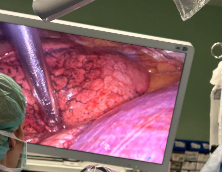 tumores cancer de pulmon